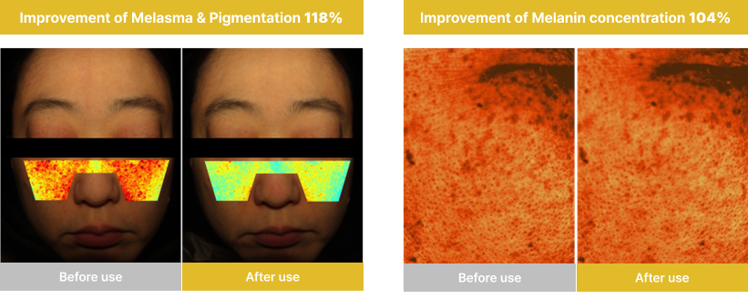 Improvement of Melasma, Melanin concentration