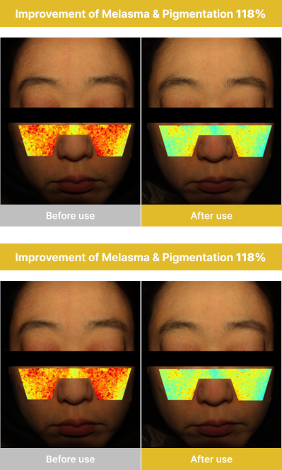 Improvement of Melasma, Melanin concentration